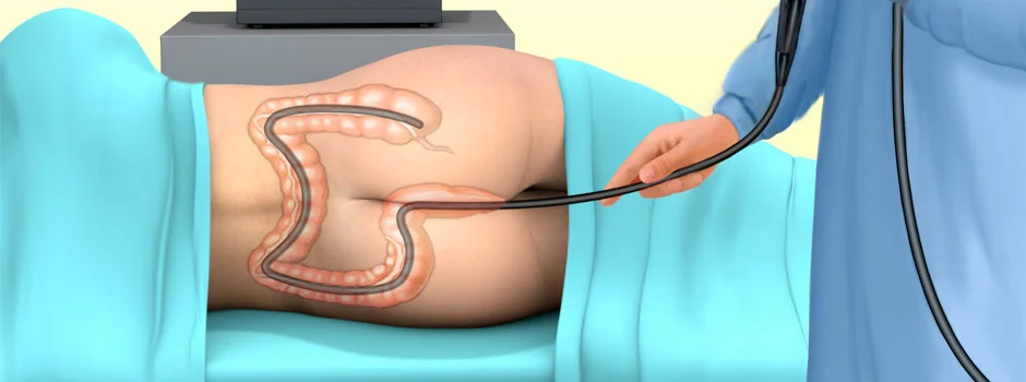 Colonoscopy Image