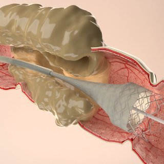 Esophageal/Colonic Metallic Stent Placement
