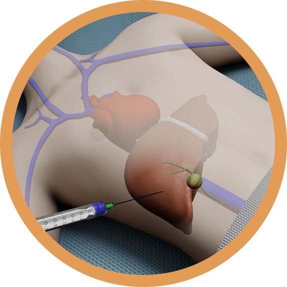 EUS Guided Fine Needle Biopsy
