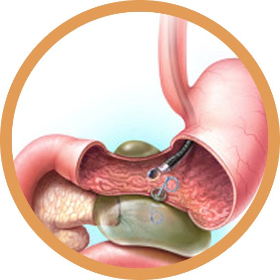 EUS Guided Pseudocyst Drainage