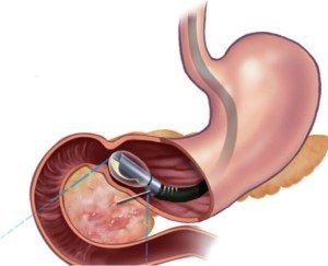 Endoscopic Ultrasonography Procedure