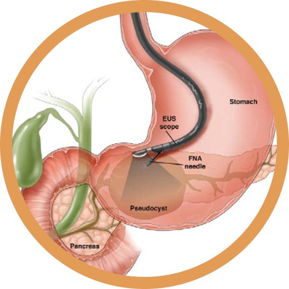 EUS (Endoscopic Ultrasonography)