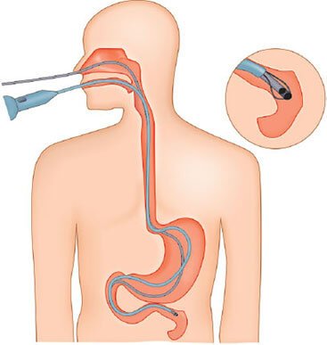 Nasogastric Nasojejunal Tube Placement