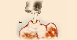 Variceal Band Ligation / Glue Injection / Sclerotherapy